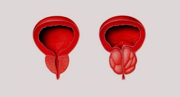 Próstata sa (esquerda) e inflamada por prostatite (dereita)