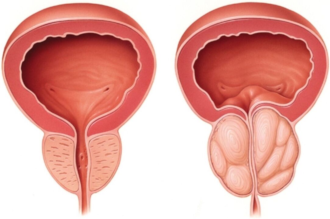 Próstata normal (esquerda) e con signos de inflamación na prostatite (dereita)