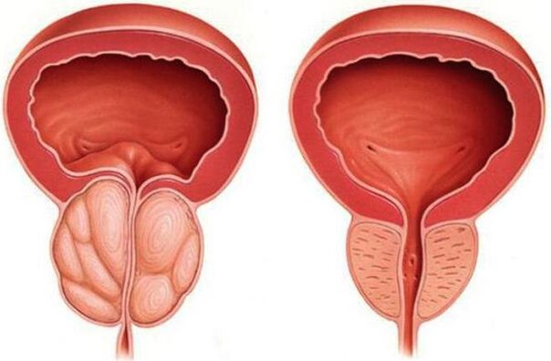 próstata sa e inflamada con prostatite